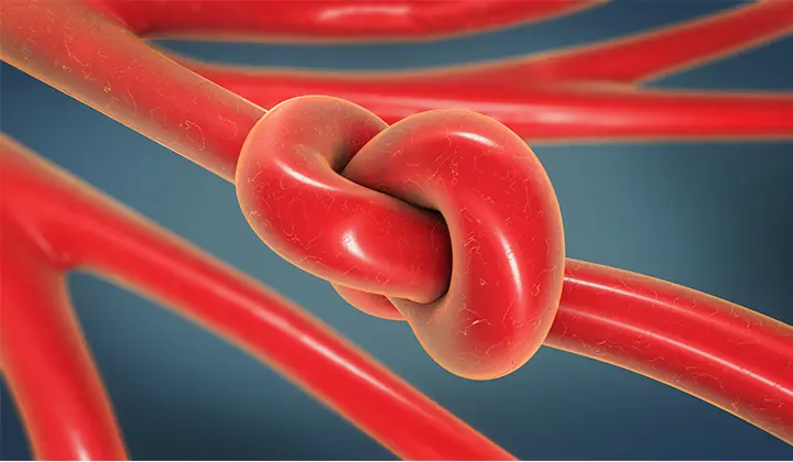 Knoten im Darm bei Verstopfung