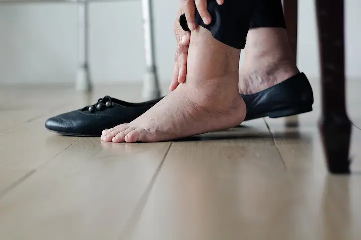 What is edema, why does it occur and how is it treated?